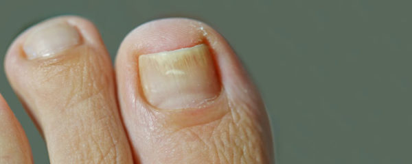 Psoriasis des ongles