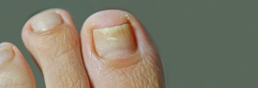 Psoriasis des ongles