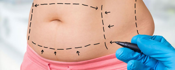 abdominoplastie