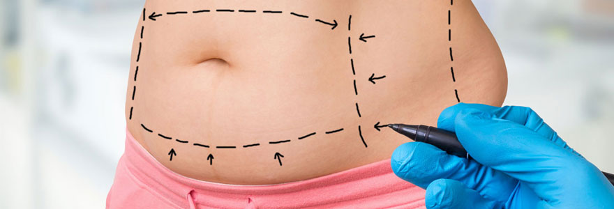 abdominoplastie